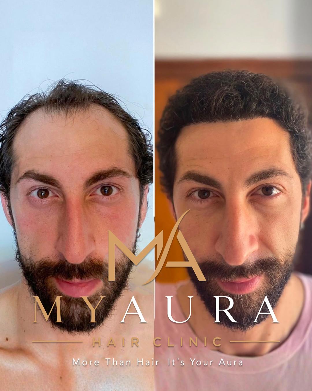 Avant / Après