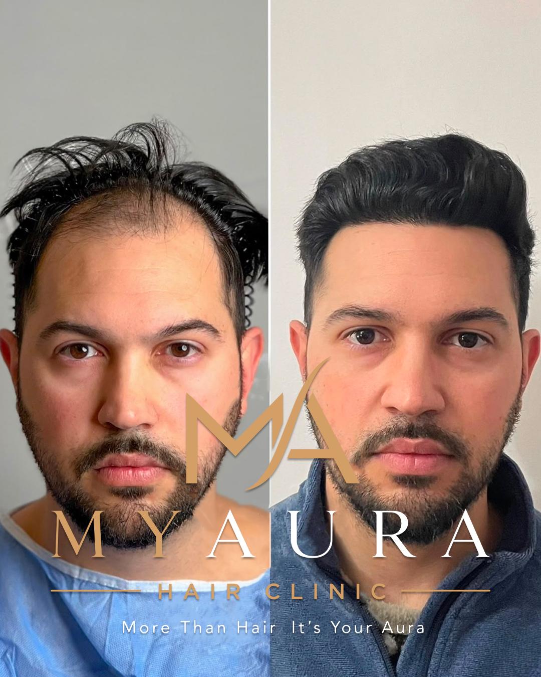 Avant / Après